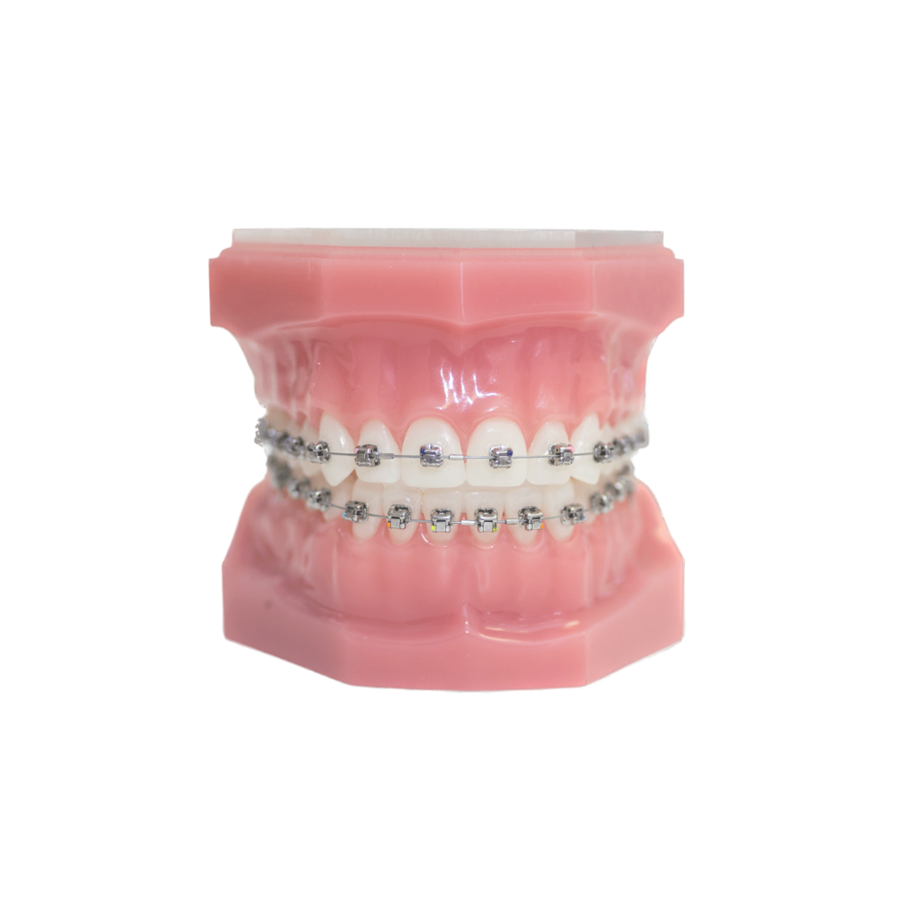 Dental model with Damon Ultima™ Braces in Norwich, CT.