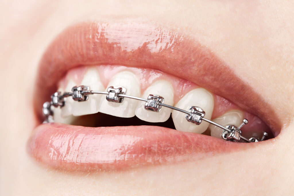 Close up of the smile of a woman with Damon braces and salmon colored lip gloss