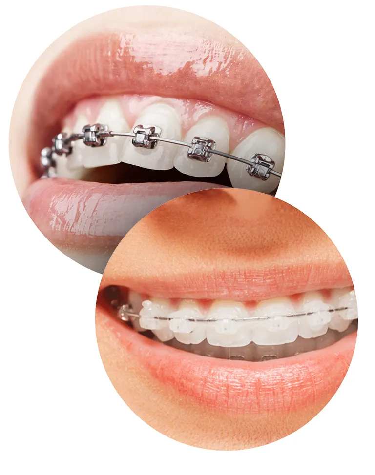 Close up of the smiles of two young woman with metal & clear braces